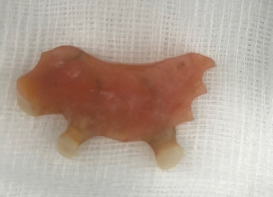 dị vật răng giả