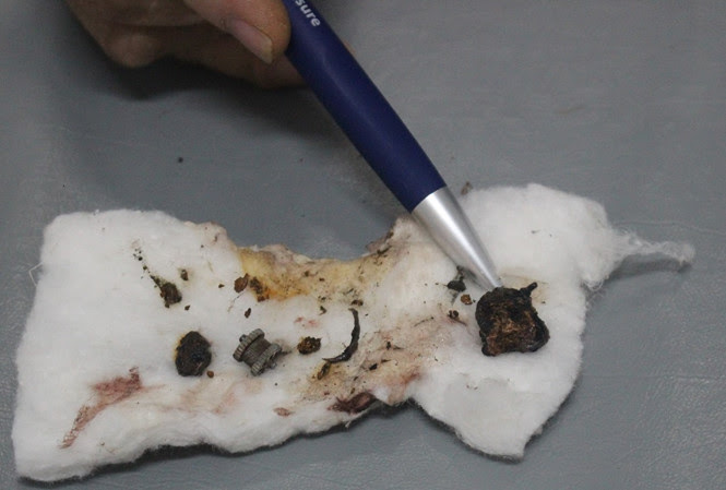 dị-vật-lưỡi-câu